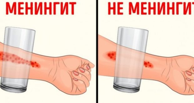 8 опасни признака на менингит, които всеки родител трябва да познава